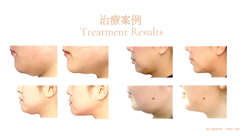 Inner B SE新一代胜肽消脂針 趕走眼袋, 雙下巴, 拜拜肉及其他頑固脂肪 Beauty Academy HK